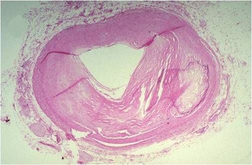 Atheroma Formation With Hypercholesterolemia Diet